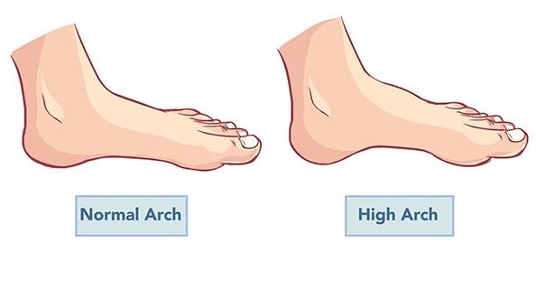 What Kind of Problems Are Caused by High Arches