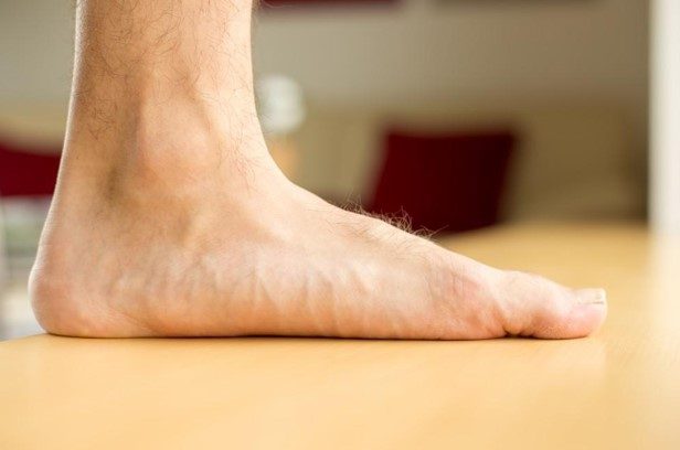 Can Flat Feet Be Corrected