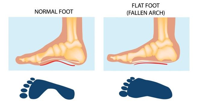 What Makes Someone Flat Footed